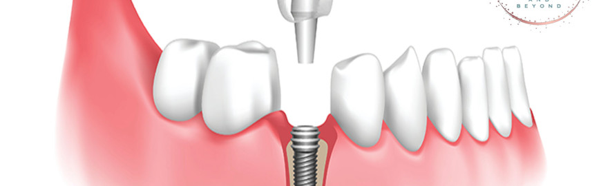 all on 6 dental implants cost in india