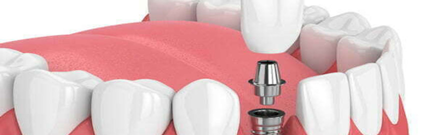 Dental implants cost