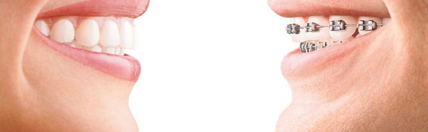 invisalign cost chennai