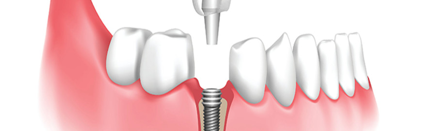 Implant teeth price in Malaysia